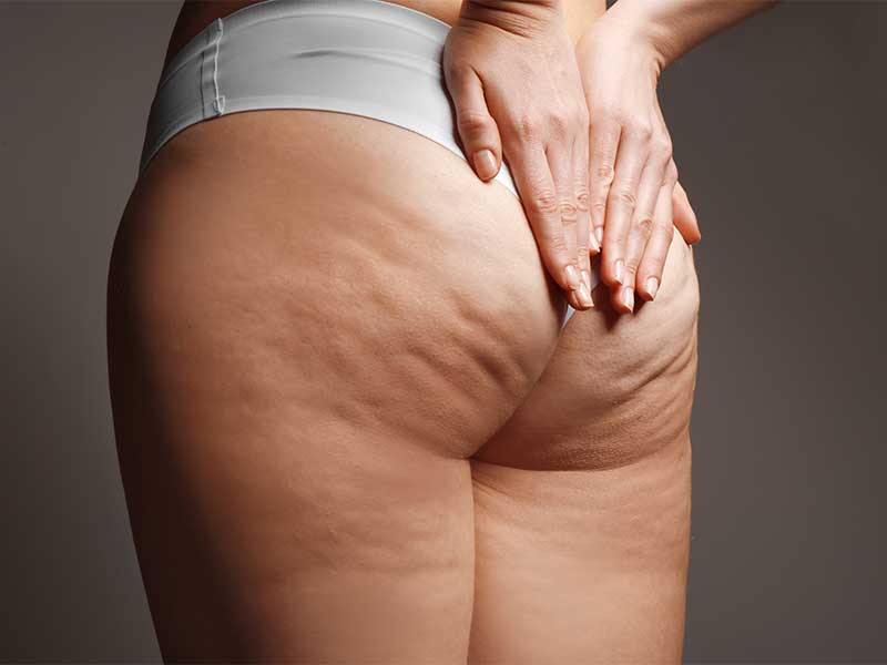 Was ist Cellulite, Ernährung und Sport gegen Cellulite, Massagen & Wechselduschen + FAQ.